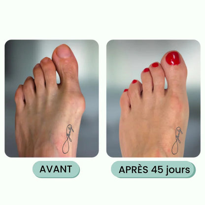 Correcteur d'hallux valgus