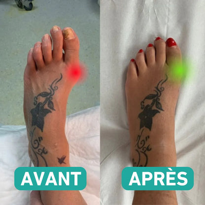 Chaussette correctrice Hallux valgus